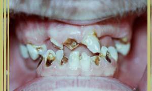 Meth Mouth image shown on Frontine