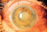 Anterior chamber Angle closure Iritis Hyphema Blunt Eye