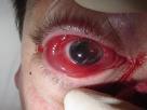urgent referral Intraocular Foreign Body History is