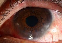 Contact Lens Issues Overwear /