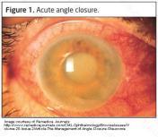 Glaucoma Many types IOP crucial in all Emergent
