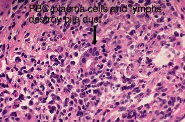 Autoimmune disease involving lymphocyte-mediated destruction of bile duct epithelium Primary Sclerosing Cholangitis Inflammation, obliterative fibrosis &