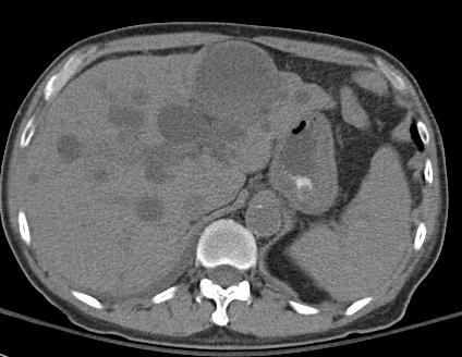 Liver Cyst Infection 1/07 CT- Anatomic