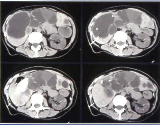 Autosomal Dominant Polycystic Liver Disease: Alcohol Sclerosis of Liver Cysts Success