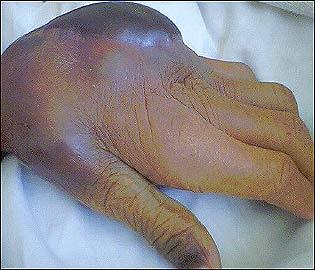 Left-hand hematoma developed 3 days after surgical incision of the