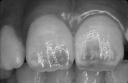 Fluorosis is