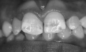 Molars SYSTEMIC