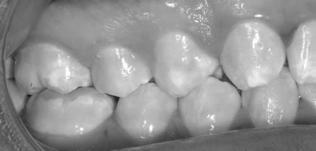 Fluorosis and