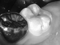 CJ s Fluorotic Molars Fluorosis