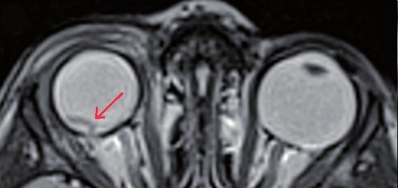 In our ptient, we were looking pthologiclly for evidence of extroculr tumor extension t the site tht ws seen in MRI.