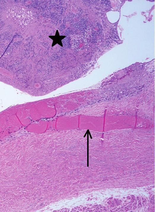 Turkish Journl of Pthology Yousef YA et l: Concomitnt Retinoblstom nd Hemngiom C D Figure 3: Histopthologic sections showed A) Retinoblstom (lck strt) overlying nother melnotic choroidl