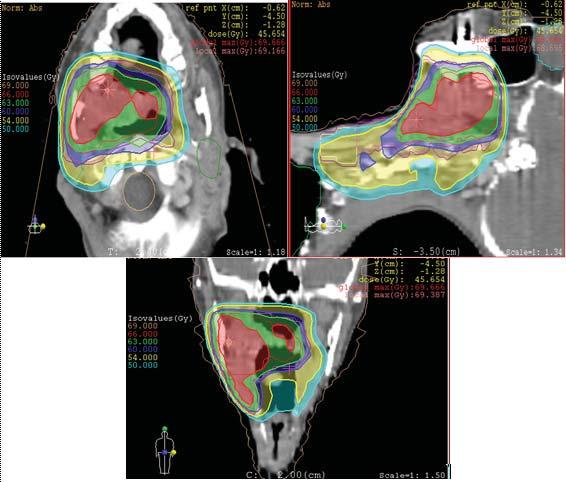 A forward Planning Intensity-Modulated Radiation Therapy with Simultaneous Integrated Boost Fig.