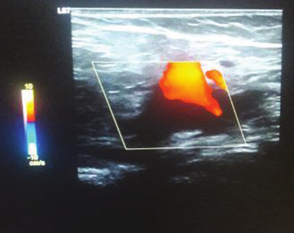Dilated superficial vein with perforators(grey scale) Image-1: Sapheno-femoral junction showing reversal flow during valsalva Image-2: Sapheno-femoral junction showing reflux during valsalva (8%).