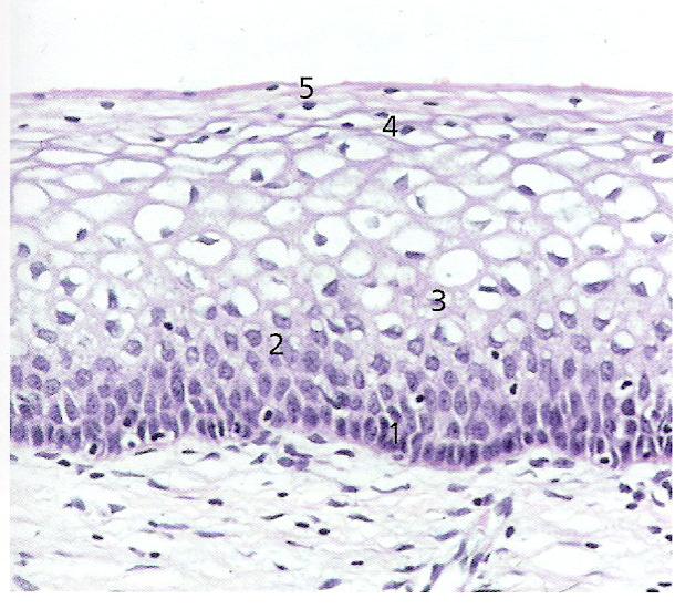 5 mature surface squames This is normal squamous epithelium with maturation of the basal layer to eventually form flattened superficial squames with pyknotic (small) nuclei.