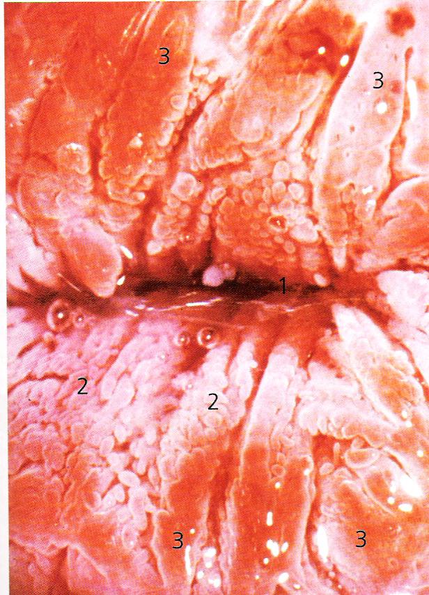 Immature squamous metaplasia with squamous epithelium beginning to cover some crypts. Immature squamous epithelium is relatively glycogen deficient.