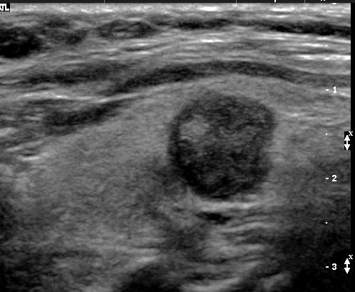 Ultrasound Left lobe sagittal No other