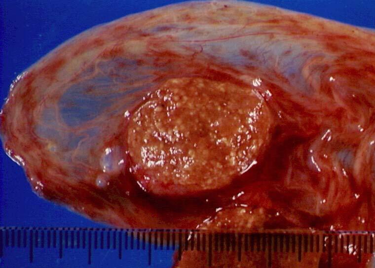 Parasites infecting the foetus Toxoplasma infection of sheep placenta Bristol