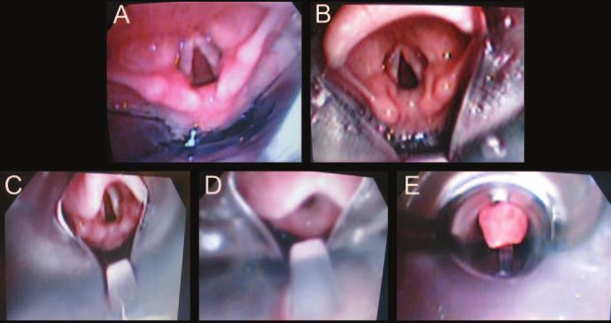 Intubating Laryngeal Airway as a Conduit for Tracheal Intubation in Children Figure 2.