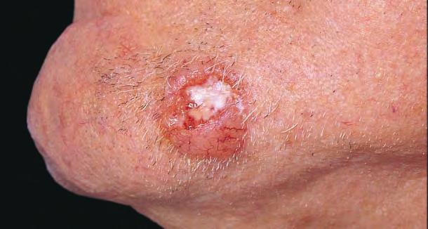 1 Epidemiology Basal cell carcinoma Basal cell carcinoma (BCC) is the most common malignant neoplasm in white individuals.