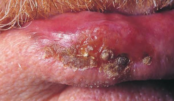 Fast Facts: Skin Cancer Figure 1.3 Squamous cell carcinoma on the lip these lesions predominantly occur on sun-exposed sites, particularly the head and neck.