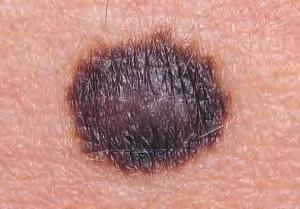 Junctional nevus most commonly arises in childhood and early adulthood.