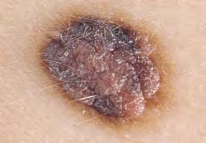 Compound nevus is a slightly elevated well-delineated pigmented lesion, most commonly found in