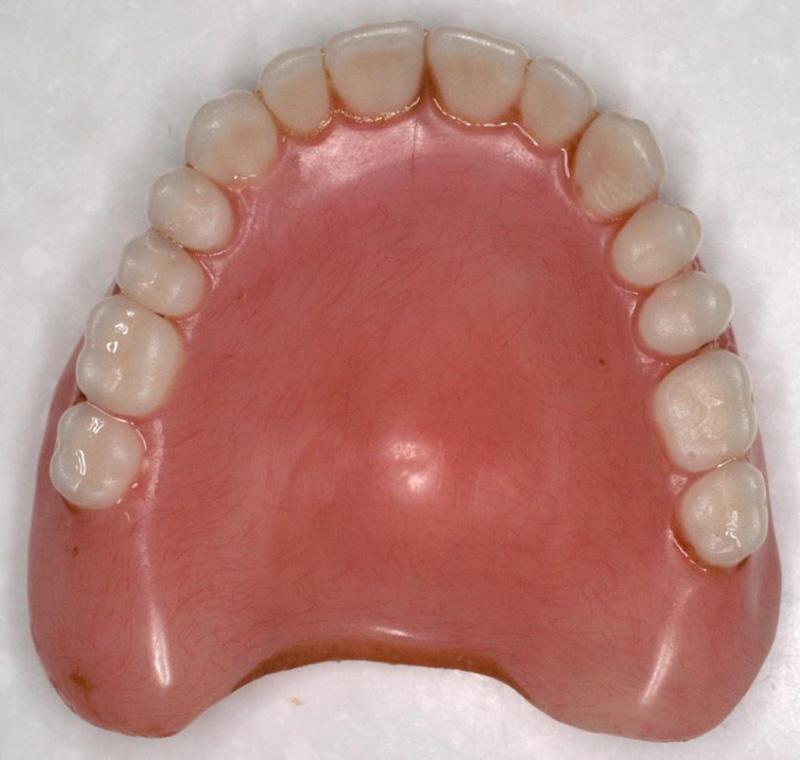Interestingly the patient had no complaints pertaining to the fit or occlusal surface, but from a clinical and technical perspective improvements could be made.