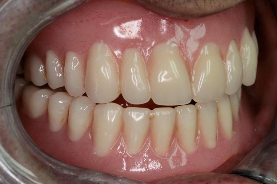 Construct new upper and lower dentures using copy technique to replicate tooth position and polished surfaces, but allow for minor improvements to mould, shade and arrangement. 3.