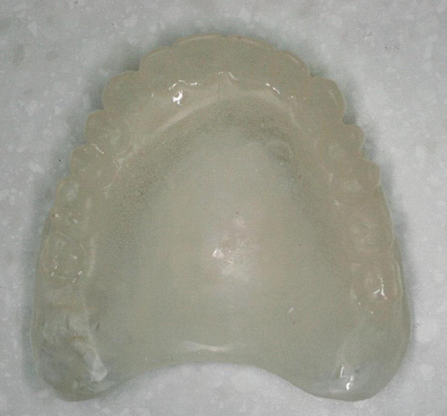 68 Singapore Dental Journal 35 (2014) 65 70 Fig. 13 ZnOE wash in upper copy. Fig. 10 Acrylic copy of upper denture. Fig. 11 Acrylic copy of lower denture. Fig. 12 Acrylic copies in situ.