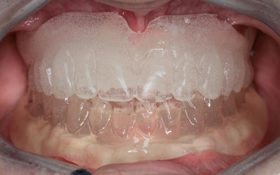 Border moulding is also easier with the open mouth technique. If the OVD is recorded and checked at each Fig. 14 ZnOE wash in lower denture.