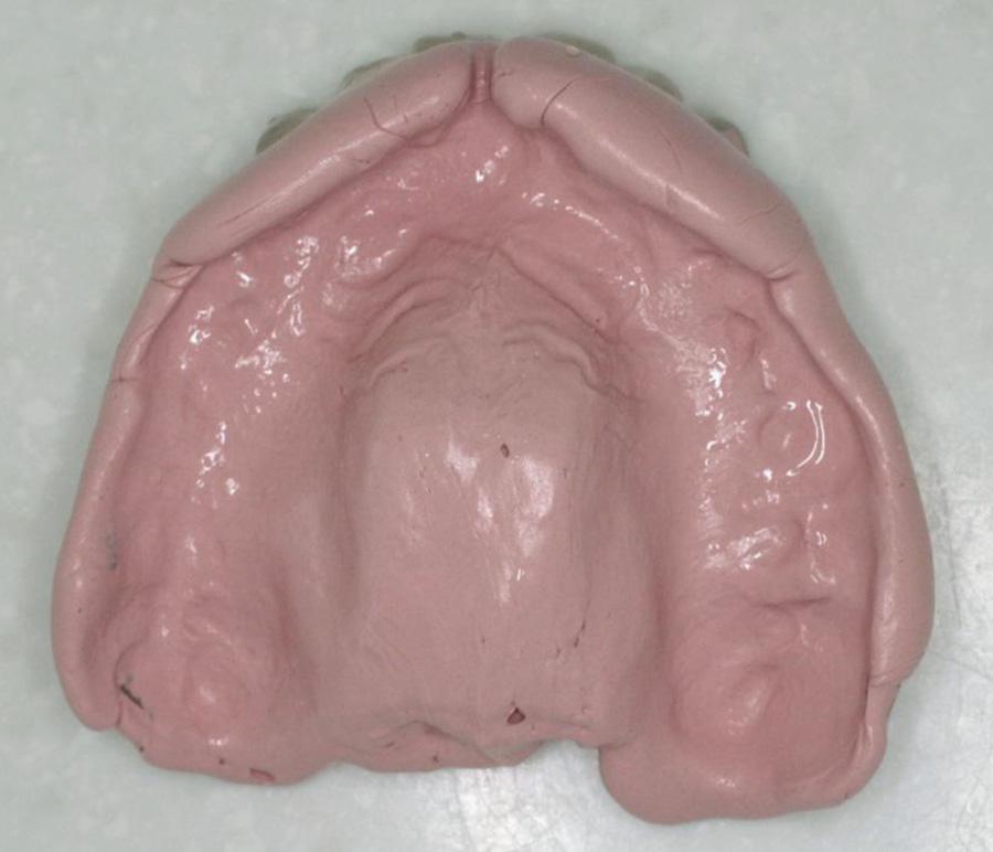Silicone jaw registration material to be used (Fig. 15). The acrylic copies serve a double purpose i.e. that of a registration block as well as special tray.