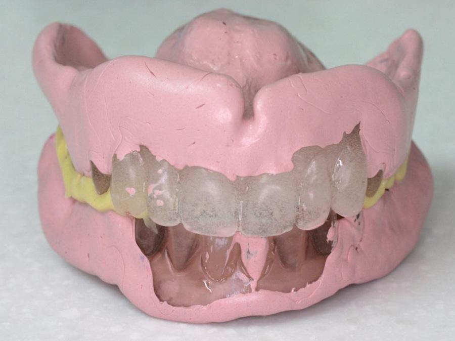 Singapore Dental Journal 35 (2014) 65 70 69 Fig. 15 Jaw registration with silicone material. Fig. 18 Finished dentures in situ. Fig. 19 New dentures in protrusion. Fig. 16 Tooth try-in on articulator.