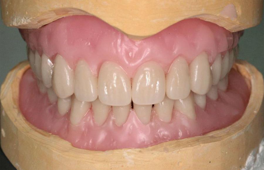 Finish in pink veined high impact acrylic and delivery of dentures (Figs. 18 24). Discussion Fig. 17 Tooth try-in in situ.