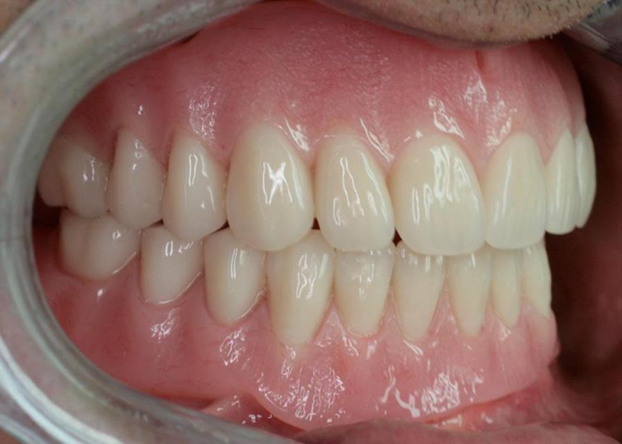In these types of cases, copies can be made of the dentures for trial modifications, such as extending borders, adding post-dams, balancing occlusion and increasing or reducing OVD.