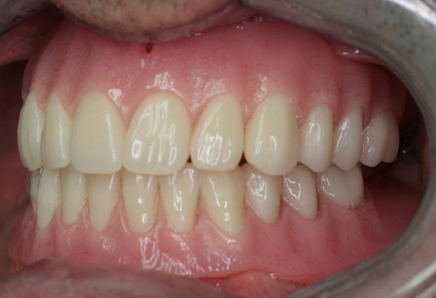 70 Singapore Dental Journal 35 (2014) 65 70 Fig. 21 Balancing contacts on the left in right lateral excursion. Fig. 22 New dentures in left lateral excursion. Fig. 24 A satisfied patient.