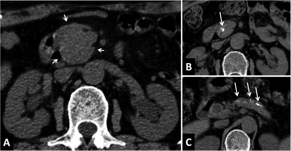 Maruyama et al. Orphanet Journal of Rare Diseases 2014, 9:77 Page 4 of 12 Figure 1 CT findings in a 67-year-old woman with pancreatic head swelling.
