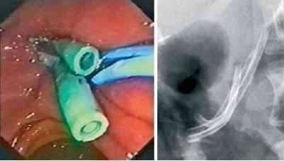 ENDOSCOPIC THERAPY CP REFRACTORY PANCREATIC STRICTURE