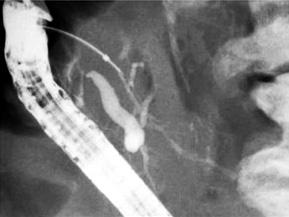 Endoscopic drainage via the minor papilla was attempted in all cases but primary minor papilla cannulation was unsuccessful in four cases.