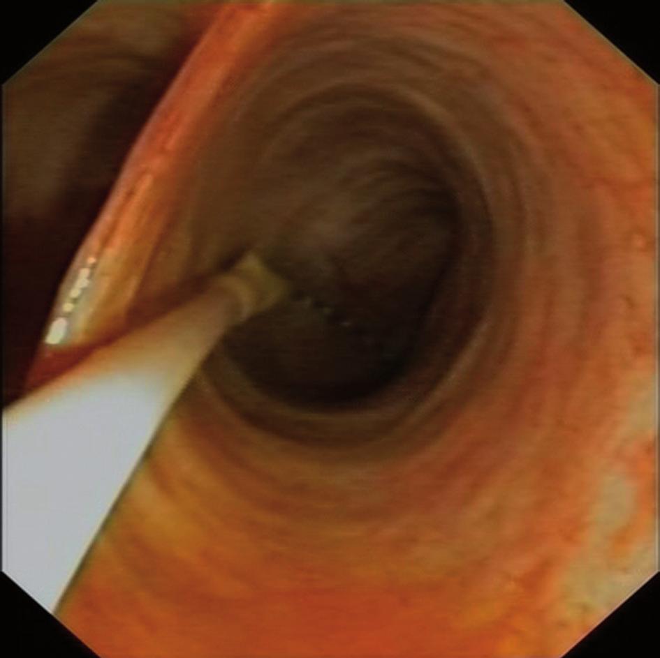 Vol. 106, N.º 1, 2014 Direct peroral cholangioscopy using an ultrathin endoscope: Making technique easier 33 A B C Fig. 1. Different aspects of cholangioscopy. A. Ultrathin endoscope with anchoring balloon.