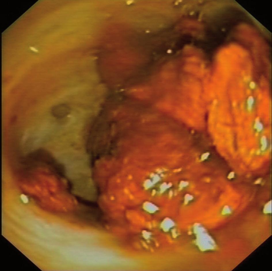 During the ERCP two complications were observed: One patient had a maintained oxigen desaturation < 85 % during cholangioscopy.