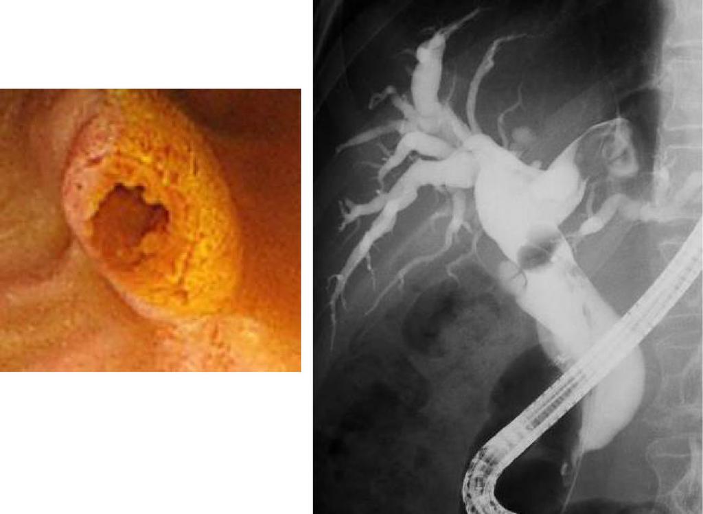 Kiriyama et al. Surgical Case Reports (2017) 3:6 Page 3 of 5 a b Fig. 3 a. Duodenoscopy. The orifice of the Vater s papilla was expanded by mucus. b. Endoscopic retrograde cholangiography.