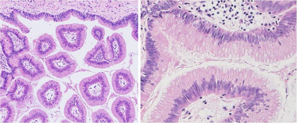 Kiriyama et al. Surgical Case Reports (2017) 3:6 Page 4 of 5 Fig. 5 Histological findings.