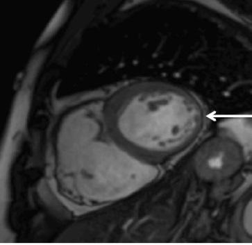 CMR and Arrythmogenic Right Ventricular Dysplasia (Case report 1) " Family history " Tissue characterization ARVD of wall (EMB) critéria " ECG abnormalities "