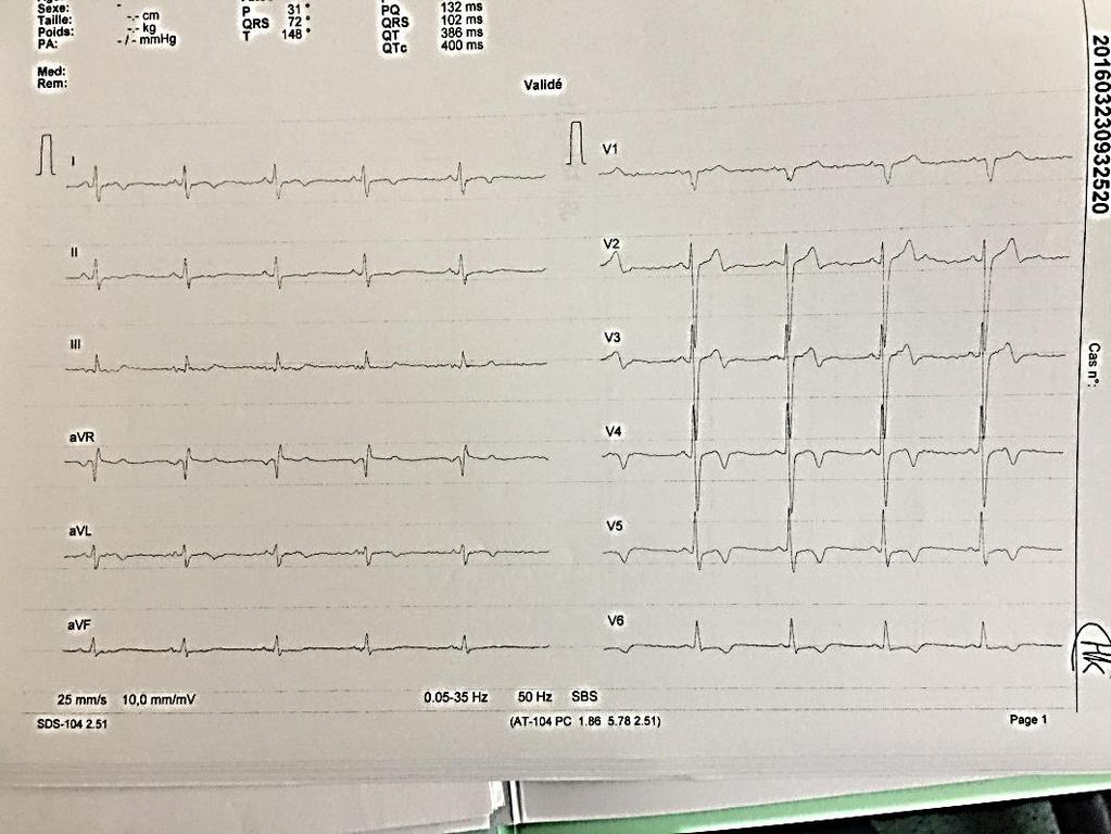 Case report 2 40 yo Air traffic controller No family history No symptom Normal clinical examination Follow up from 2000! Repolarization abnormalities V4!