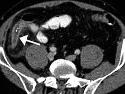 6 B. Marincek, J.P. Heiken CT has emerged in many centers as the primary imaging modality for patients with suspected acute appendicitis due to its exceptional accuracy.