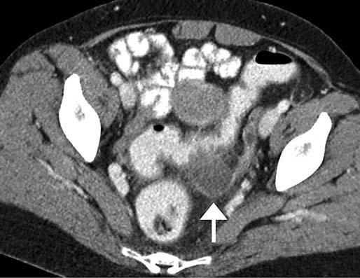 An inflammatory mass or an abscess may develop with disease progression and perforation. Diverticulitis rarely manifests itself as a right-sided condition.