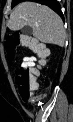 If the appendix cannot be identified, right-sided omental infarction or epiploic appendagitis must be considered in the differential diagnosis.