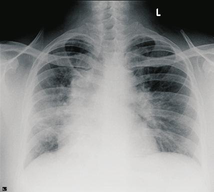 staining [a] X100,[ b] X200) in biopsy from case 2. Fig 6 : Chest X-ray showing prominent hilar lymphadenopathy in case 2.
