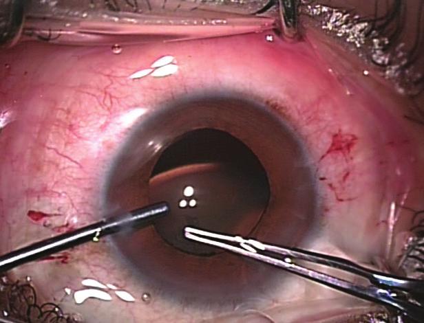 Posterior synechiae adhesions are swept with an iris repositor. Hydrodissection.