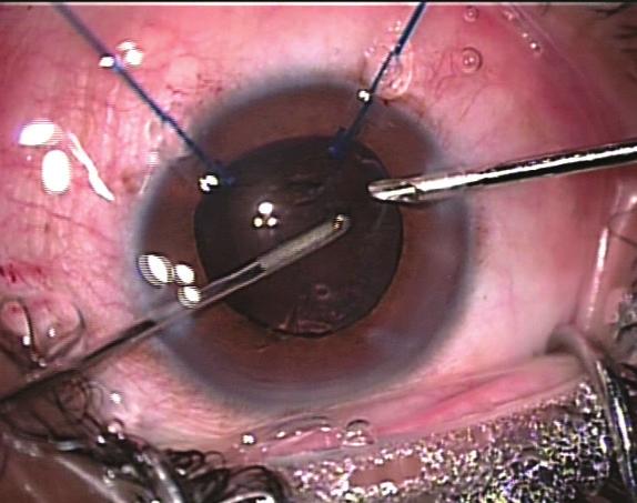The ring is first drawn up into the injector barrel, and the nozzle of the injector is inserted into the clear corneal tunnel.